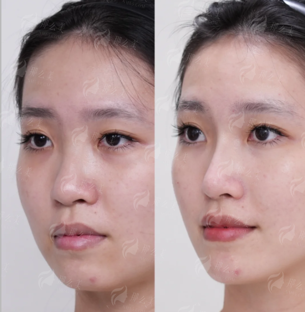 <strong>北京画美医疗美容医院斯日古楞眼部整形的特色治疗方式有哪些？</strong>