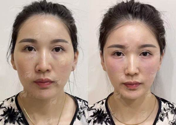 <strong>重庆华美整形外科医院刘冬阳隆胸价格参考：如何正确预约与面诊？</strong>