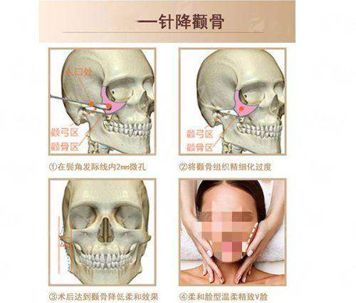 <strong>三、在哈尔滨选择“大脚骨”矫正，如何对比与预约？</strong>