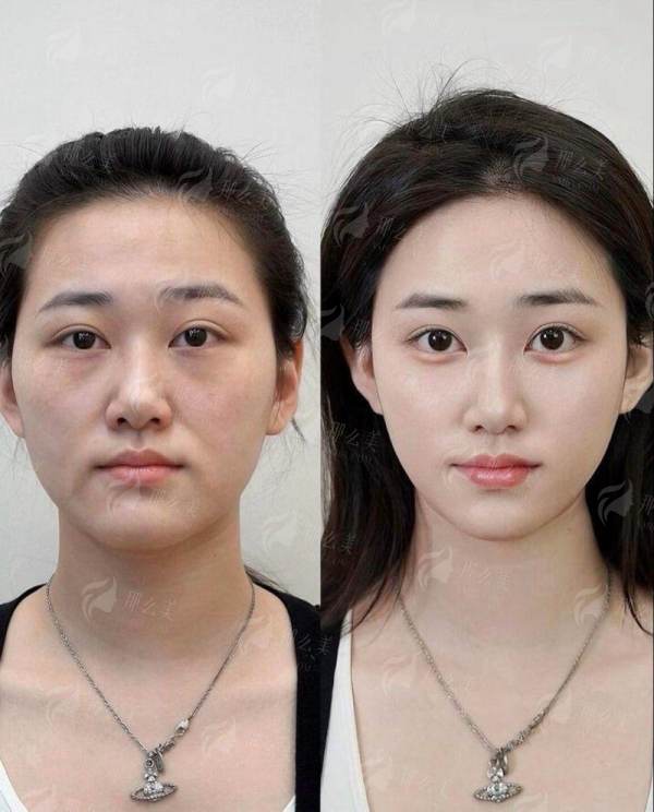 <strong>二、包头市熙妍医疗美容做眉型提升术，医生技术和审美怎么样？</strong>