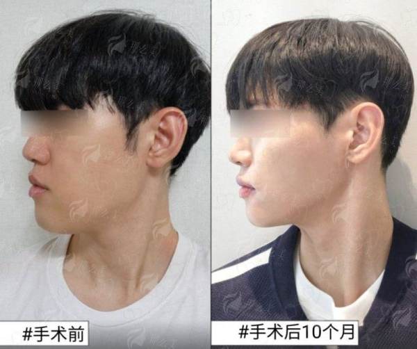 <strong>四、在呼和浩特进行发际线种植，如何选择与总结建议</strong>