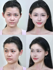 南宁东方腰腹吸脂真实效果分享，价格了解与案例推荐，新颜智尚小程序一键预约