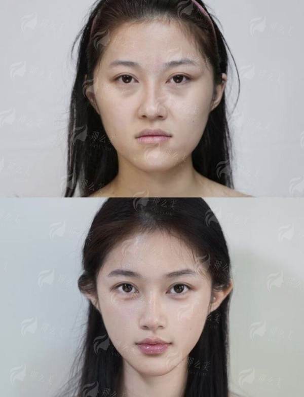 <strong>三、哪些人特别适合考虑佛山曙光李淑薇医生的双眼皮手术?</strong>