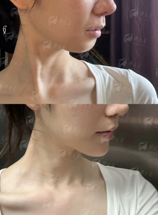 <strong>二、深圳鹏程整形医院的刘冰医生假体丰胸有什么独特优势？</strong>