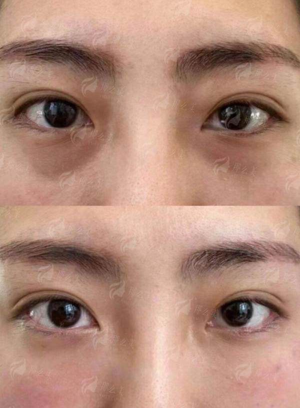 飞秒激光手术在合肥普瑞眼科医院做怎么样？新颜智尚小程序预约，查看医院介绍与价格