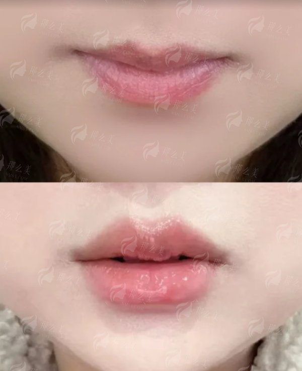 北京煤医西坝河史芳双眼皮靠谱吗？看这3个真实案例就懂！新颜智尚小程序一键预约，省心高效不排队