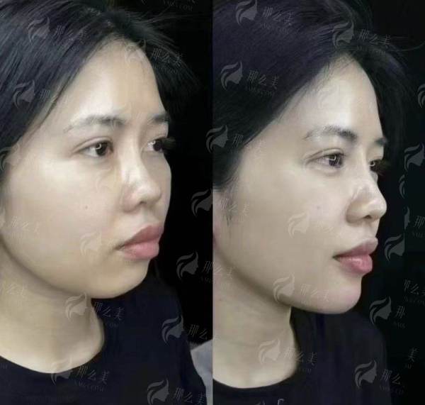 <strong>三、江苏苏州问兰医疗美容贾飞医生双眼皮整形,价格与价值如何考量?</strong>
