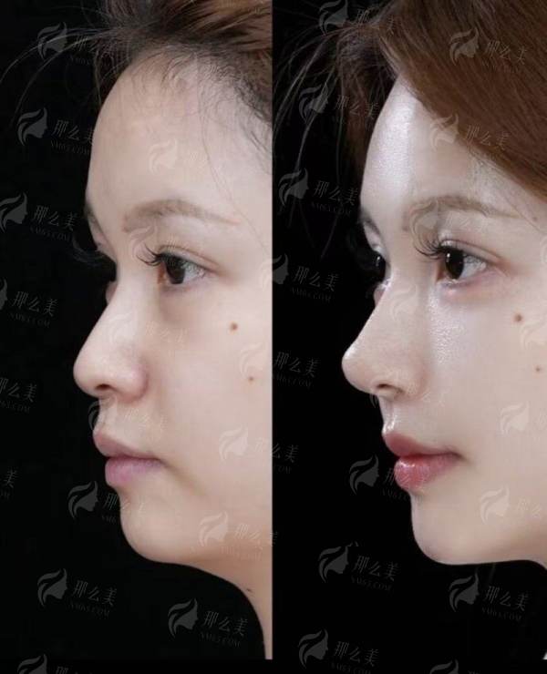 <strong>三、杭州薇琳的大腿吸脂价格与医生如何选择？</strong>