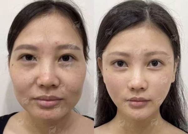 <strong>二、杭州薇琳的大腿吸脂过程与修复期是怎样的？</strong>