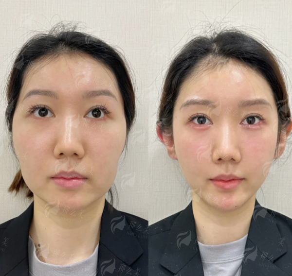 <strong>三、桐乡星博士医疗美容医院的筋膜支架提升术后如何护理？修复期要多久？</strong>