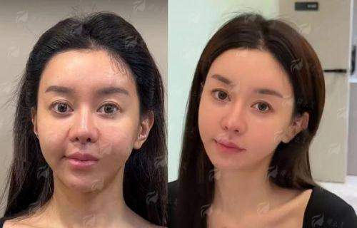 <strong>三、<strong>广东清远时光医疗美容的线提升提升价格与同城对比</strong></strong>