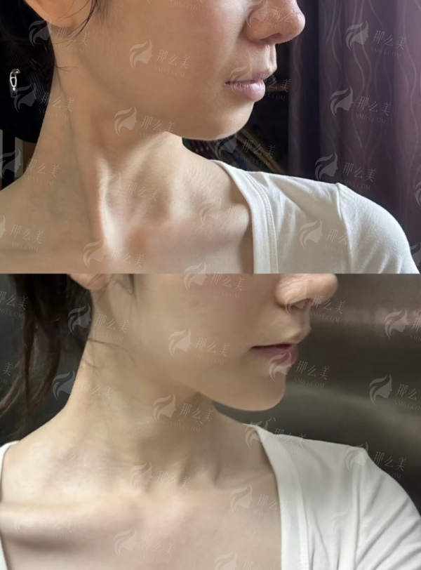 <strong>二、于艳菊医生祛疤痕在武汉美莱的具体流程与体验是怎样的？</strong>