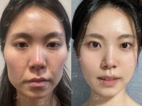 <strong>四、连云港美缔医疗美容的假体隆鼻术后护理与成效如何保护?</strong>