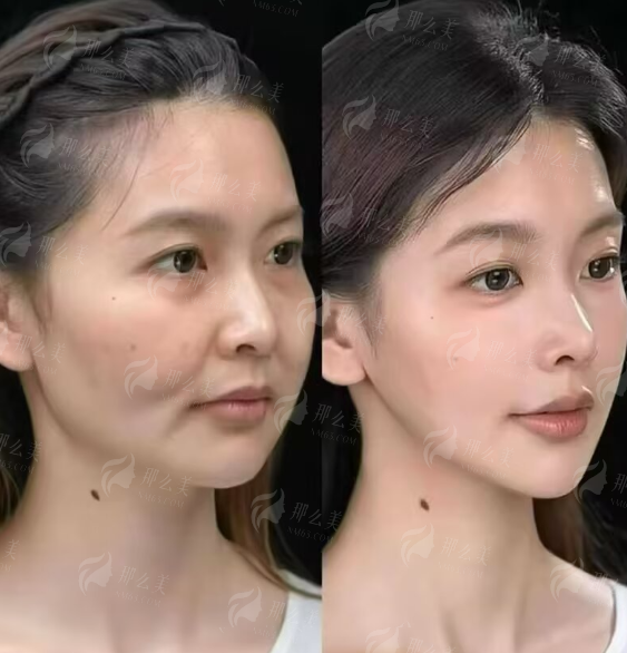 <strong>二、<strong>在郑州喜丽整形医院做腰腹吸脂，成效和流程是怎样的？</strong></strong>