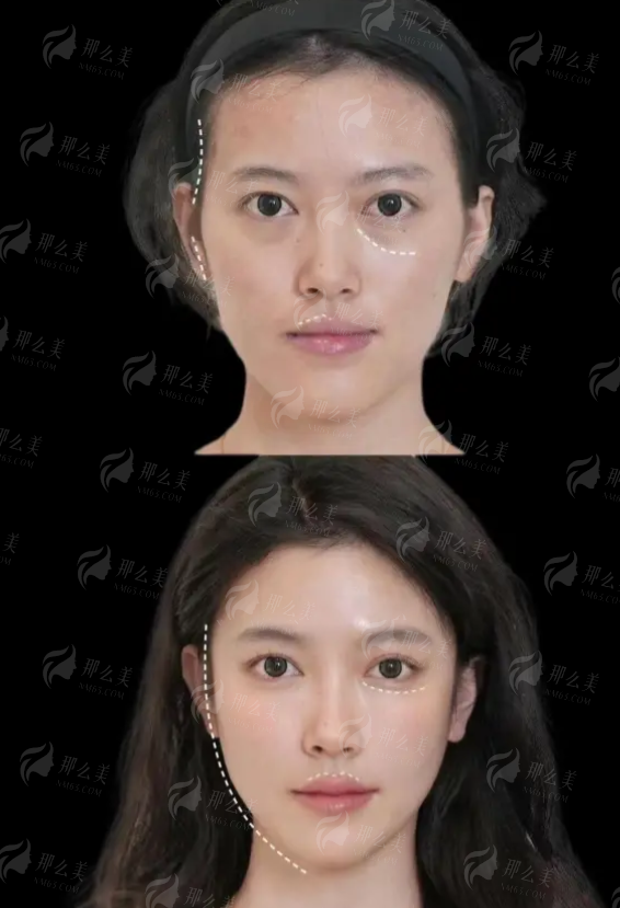 <strong>三、福州海峡美容医院微拉美双平面提拉，价格大概要多少？</strong>