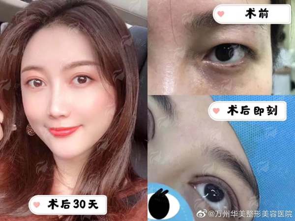 三、多维审视:吸脂实例分享与成效对比