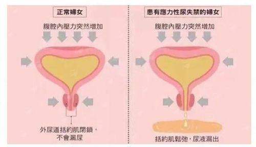 <strong>三、<strong>重庆华美整形外科医院的隆胸修复流程与术后护理是怎样的？</strong></strong>