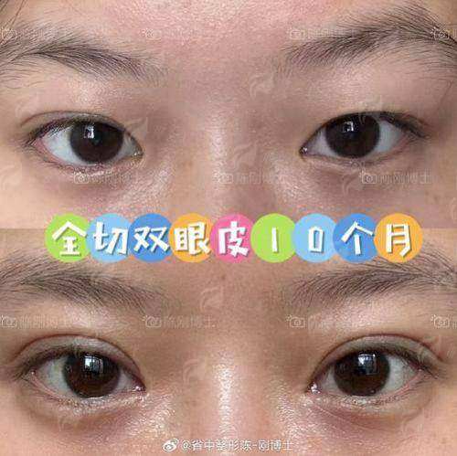 长春融美医疗美容双眼皮价格表案例及地址信息-新颜智尚小程序一键预约！