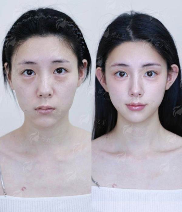 <strong>二、<strong>南宁美丽焦点的肋骨鼻成效能维持多久？</strong></strong>