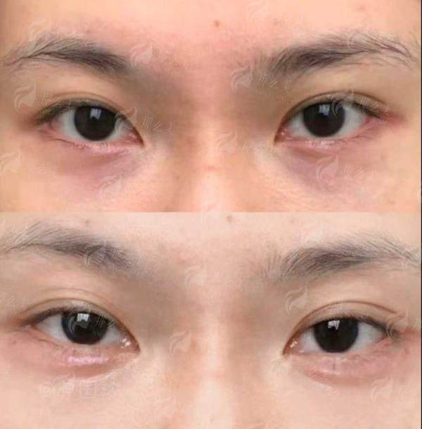 <strong>三、<strong>在南宁美丽焦点做肋骨鼻有什么优势？</strong></strong>