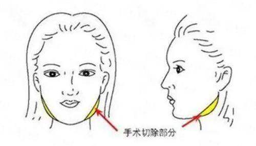 <strong>二、广州中家医黄广香医生拉皮手术，具体有哪些技术方案？</strong>