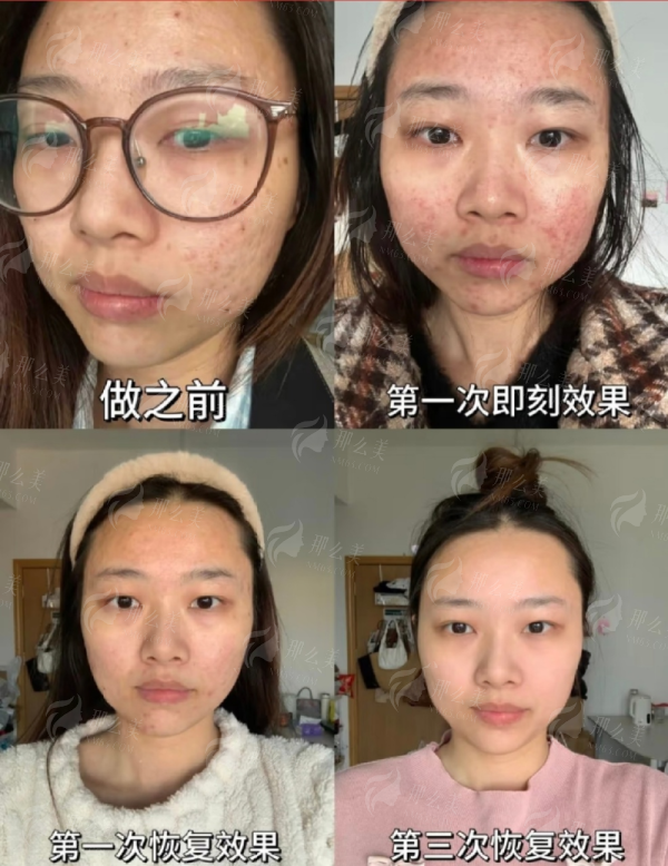 <strong>哪些人是南京康美李成成非手术祛眼袋的适合人群？</strong>
