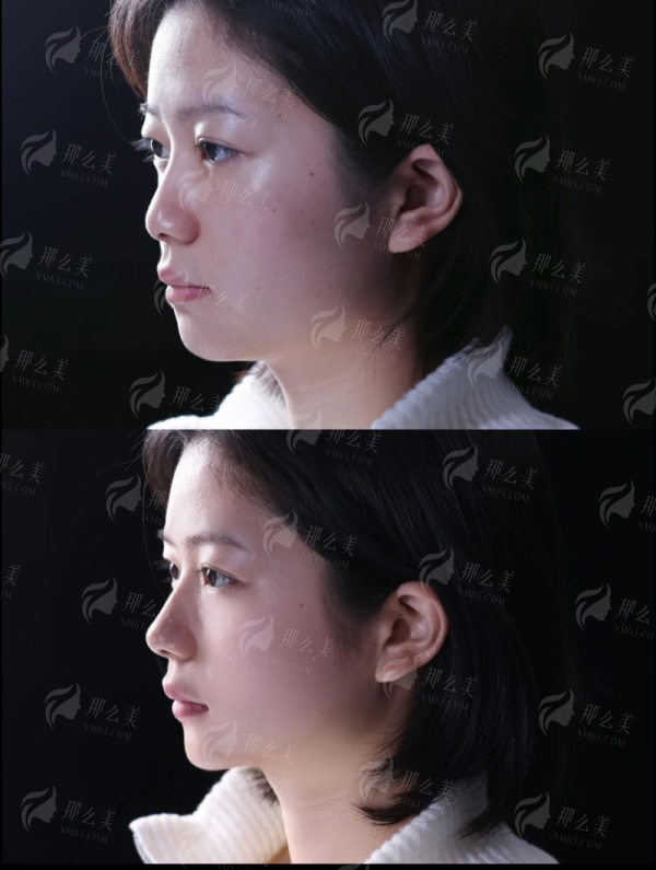 <strong>河南整形美容医院刘凤斌歪鼻矫正价格指南(2026年参考)</strong>