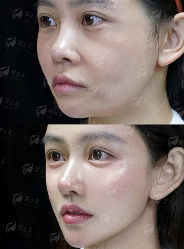 <strong>求美者更关心:成都邓东伟肋软骨隆鼻的价格区间与收费构成?</strong>