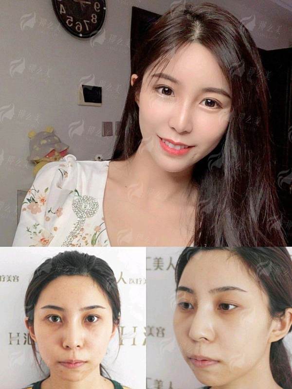 <strong>高端仪器加持:湖北荆州安美聚光魔龄的“斑疤痘”克星设备</strong>