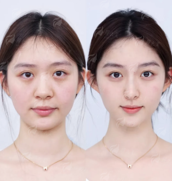 <strong>揭秘“超能光雕”特色治疗：如何实现不开刀祛眼袋？</strong>