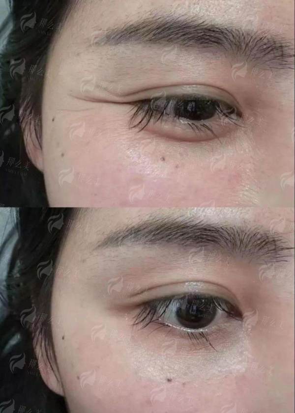 <strong>苏州紫馨童颜针的特色治疗方式：超越传统注射的“定制化再生方案”</strong>
