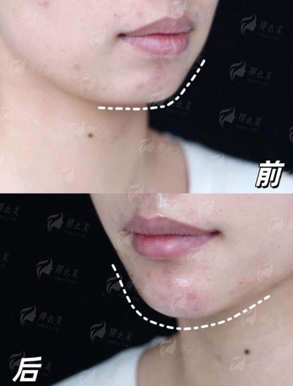 <strong>三、<strong>在广东深圳做拉皮手术,价格和成效如何考量?</strong></strong>