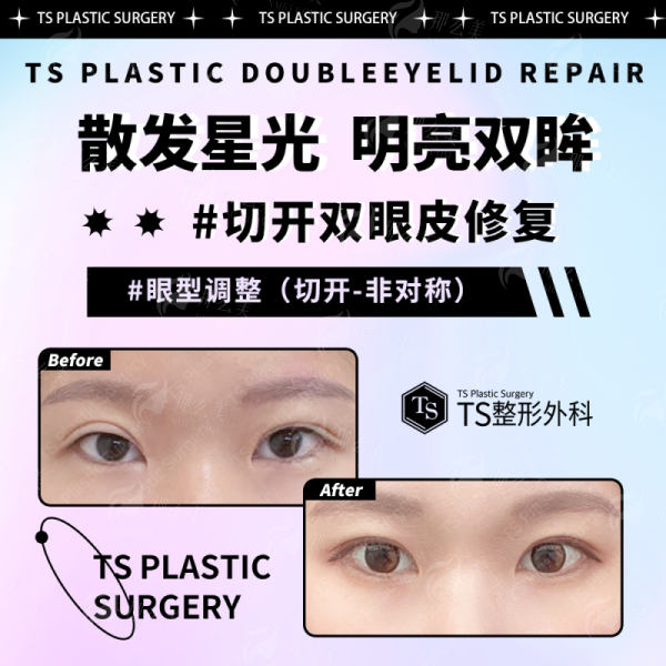 <strong>深圳安美聚光假体隆胸的服务质量与术后护理体系</strong>