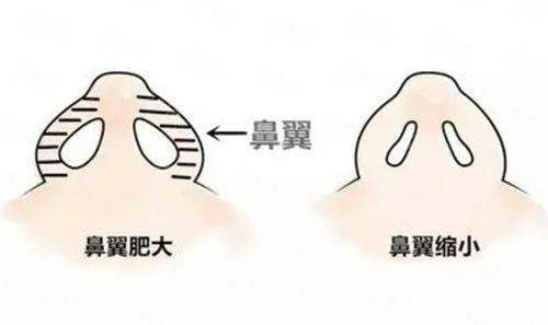 <strong>三、在湖北襄阳伊莱美医疗美容做拉皮，流程与护理是怎样的？</strong>