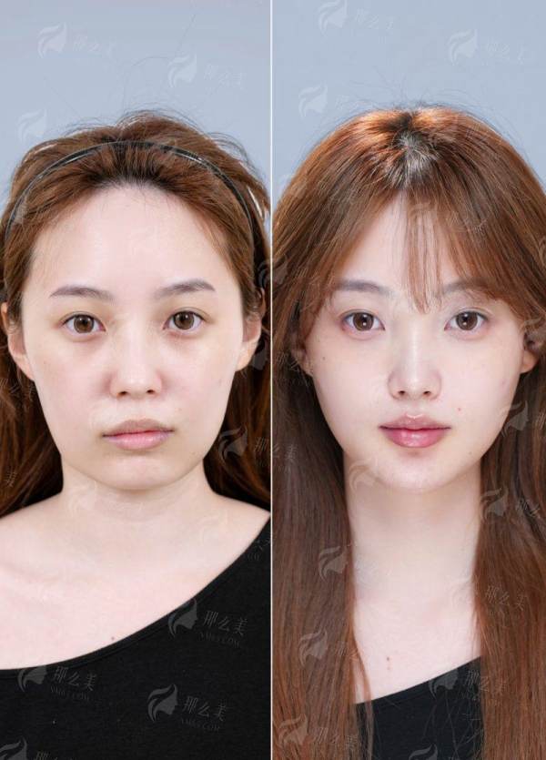 <strong>二、江苏苏州光明眼科医院的半飞秒手术适合哪些人？</strong>