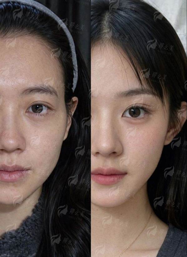 <strong>四、杭州连天美医疗美容医院“大脚骨”矫正，如何选择与更终决策？</strong>
