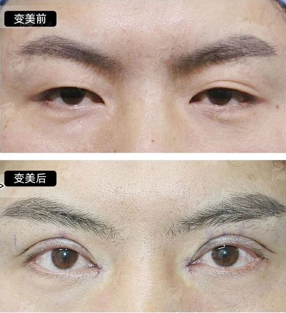 <strong>三、<strong>深圳福雅范人中缩短的价格、修复与口碑如何?</strong></strong>