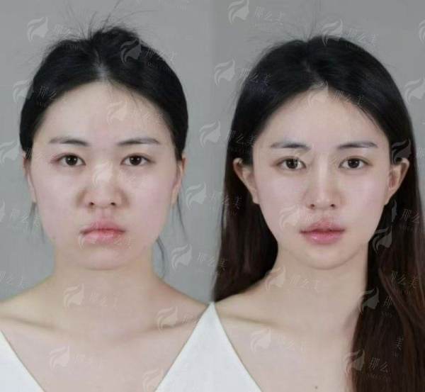 重庆星荣刘正茂PEEK人工骨下颏填充：为何能成为“轮廓定制的硬核担当”？