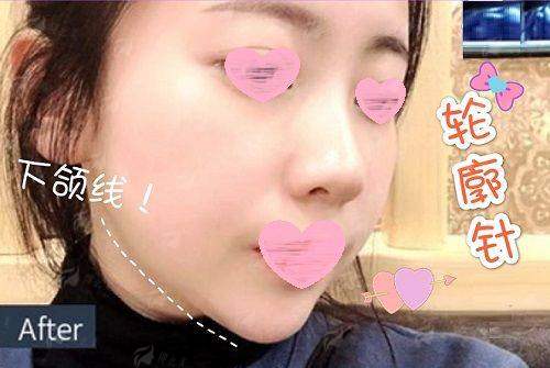 <strong>求美者更关心:沈阳杏林房红超埋线提升的价格与成效</strong>