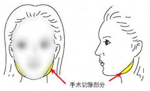 <strong>三、江苏淮安艺后医疗整形医院的陈男男植发术后保护如何?</strong>