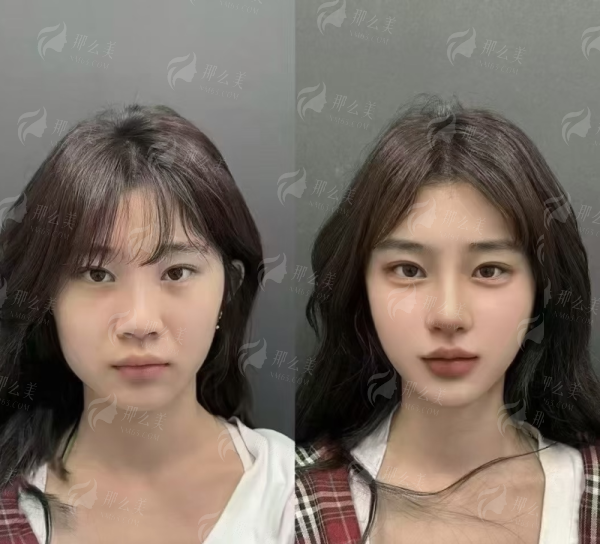 <strong>浙江杭州清锴医疗美容门诊部金柱假体隆鼻的核心优势是什么？</strong>