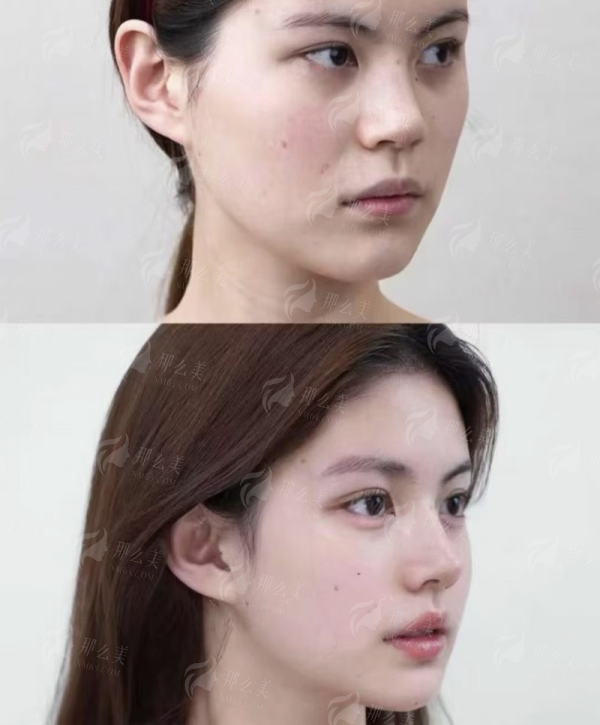 合肥韩美刘冷医生隆鼻预约火爆，特色技术与价格优惠攻略全知道