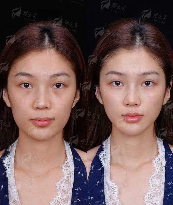 西安傲丽（原叶子）张雪院长热玛吉价格表公开！三甲背景副主任医师亲诊，新颜智尚小程序一键预约！