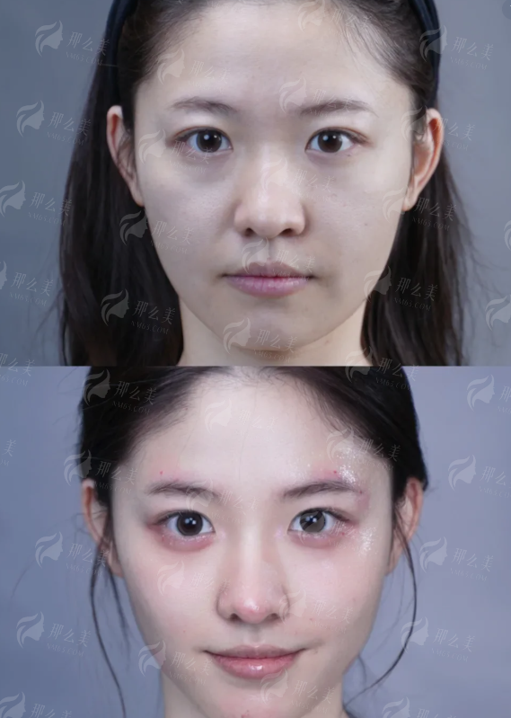 <strong>真实实例分享:看胡小青医生如何打造自然灵动的双眼皮</strong>