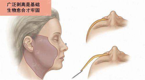 重庆星荣上官文松PEEK人工骨鼻基底凹陷修复效果如何？附价格表&案例分享，新颜智尚小程序一键预约！