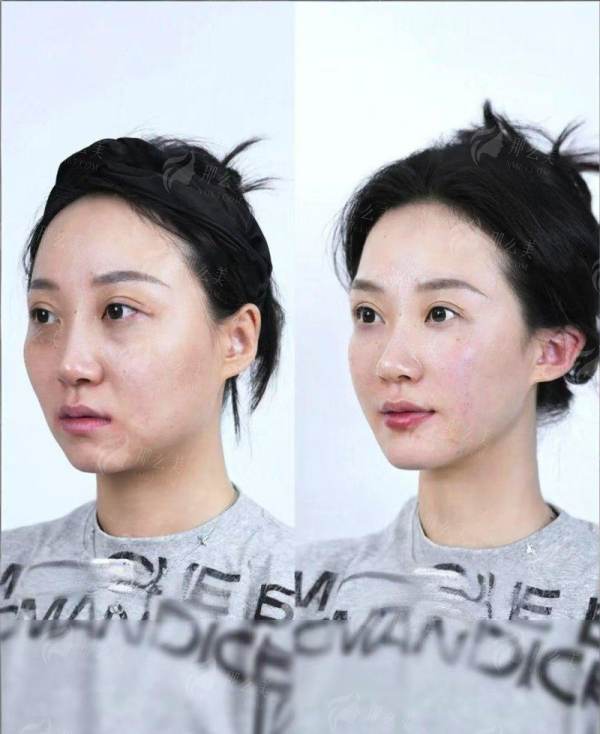 <strong>总结:为何重庆星荣上官文松PEEK人工骨方案值得考虑?</strong>