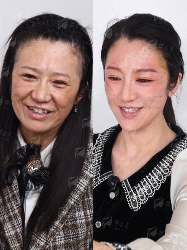 <strong>重庆星荣PEEK人工骨鼻基底凹陷矫正的价格与口碑如何?</strong>