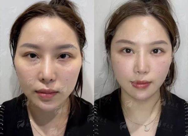 <strong>潘柏林医生的特色小口畸形治疗技术详解</strong>