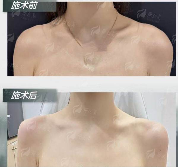 <strong>成都素美卢元刚耳软骨隆鼻的个性化方案与特色仪器</strong>