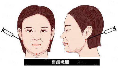<strong>二、上海韩卓医疗美容的全切双眼皮技术有何特色？</strong>
